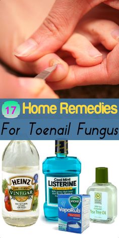 Home Remedies Store — homeremedyshop: 17 Home Remedies for Toenail... Toenail Fungus Remedies, Tongue Health, Toenail Fungus, Nail Fungus, Natural Health Remedies, Natural Home Remedies, Tea Tree Oil, Health Remedies