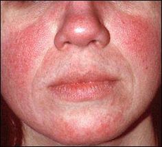 Information about standard medical treatments for signs and symptoms of rosacea. Organic Skin Care Recipes, Makijaż Smokey Eye, Sensitive Skin Care, Skin Remedies, Skin Care Recipes, Acne Skin, Organic Skin, Skin Problems