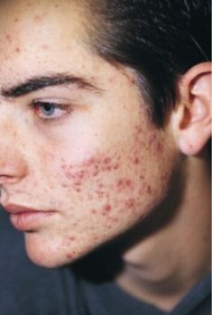 Girl With Acne, Thread Veins, Face Mapping Acne, Bad Skin, Acne Scarring, Problem Skin, Pimples On Face, Types Of Acne