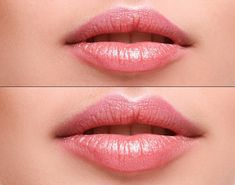 Lip Fillers in Barnsley – 5 things to know before booking Look Less Tired, Face Peel Mask, Dry Hand Skin, Combination Skin Face Wash, Lip Augmentation, Diy Lip Gloss, Lip Enhancement