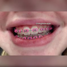 Braces Colors Ideas Cute, Braces Colors Combinations, Braces Ideas, Braces Cute, Pink Braces, Braces Colors Ideas, Braces And Glasses, Braces Smile