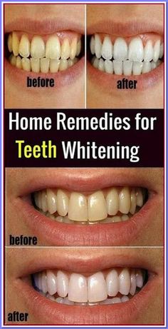 GUARANTEED! WHITEN YOUR YELLOW TEETH IN LESS THAN 2 MINUTES! Get Whiter Teeth, Yellow Teeth, Healthy Beauty, Natural Health Remedies, Natural Home Remedies