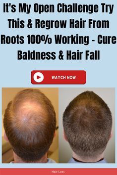 It's My Open Challenge Try This & Regrow Hair From Roots 100% Working - Cure Baldness & Hair Fall Hair Ritual, Accelerate Hair Growth, Hair Nutrition, Bald Patches, Video Nature, Kegel Exercise, Bald Hair