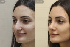 Nose Job Inspiration Natural, Books Summary, Nose Fillers