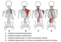 scoliosis Psoas Release, Muscle Imbalance, Psoas Muscle, Spine Health, Trigger Points, Massage Techniques, Anatomy And Physiology, Chiropractic