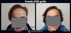 Hair Transplant Photos | Civas Hair Transplant