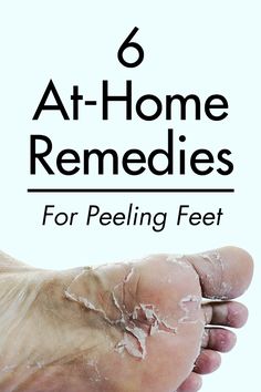 Cracked Feet Remedies, Dry Feet Remedies, Dry Skin Home Remedies, Feet Remedies, Callous Remover, Dry Skin Routine, Diy Pedicure, Dry Skin Remedies, Combination Skin Type