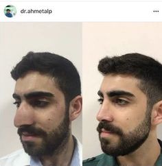 Boudiour Poses, Nose Jobs, Rhinoplasty Before And After, Ben Ten, Plastic Surgery, Surgery, Eyebrows