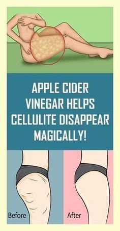 Make the Cellulite Disappear and Lose Weight With Apple Cider Vinegar Healthy Beauty, Loving Your Body, Cider Vinegar, Apple Cider Vinegar, Body Health, Apple Cider, Belly Fat, Vinegar, Cider