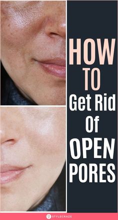 Fitness Hacks, Acne Prone Skin Care, Lotion For Oily Skin, Effective Skin Care Routine, Home Remedies For Skin, Tips For Oily Skin, Open Pores, Eye Skin Care, Skin Care Wrinkles