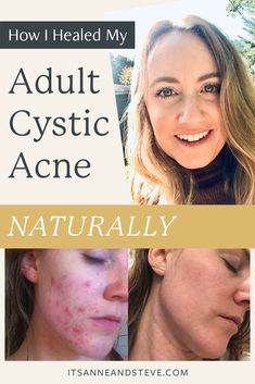 How To Get Rid Of Cystic Acne, Acne Products, Acne Skincare Routine