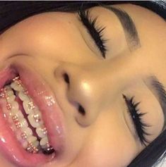 Aesthetic Braces, Pink Braces, Braces Retainer, Gold Braces, Cute Braces Colors, Pretty Teeth, Braces Girls