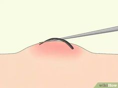 If you have an inflamed, itchy spot on your skin right after shaving, you might have an ingrown hair. Ingrown hairs are caused by hair curling up and growing back or sideways into your skin. Deep ingrown hairs can sometimes stick around... Growing Healthy Hair, Pimples Remedies, Ingrown Hairs, Hair Curling, Unwanted Hair Removal, Oral Health Care, Men's Health