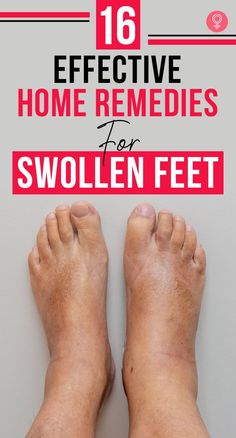 16 Effective Home Remedies For Swollen Feet: It’s time you stop suffering silently and stop treating this as a ‘not serious’ medical condition. A few hours of rest don’t always work in reducing the swelling. Here’s where our article will help you out. #remedies #homeremedies #swollenfeet #health #healthcare #healthcaretips #wellness Swollen Feet Remedies How To Get Rid, Reduce Swelling In Feet Remedies, Foot Swelling Remedy, Feet Swelling Remedies, Leg Swelling Remedies, Reduce Swelling In Legs And Ankles