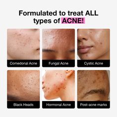 This first-of-its-kind non-gel formula combines ceramides & emollients with over 23% clinically proven ingredients to repair the skin barrier while healing & preventing different types of acne fast. Whether your acne is comedonal, cystic, hormonal, or fungal, get ready for visibly clearer skin without sacrifcing moisture & hydration. Fungal Acne Skin Care Routine, Comedonal Acne, Fungal Acne, How To Reduce Pimples, Blind Pimple, Acne Prone Skin Care, Pimples Under The Skin, Post Acne Marks, Bad Acne