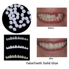 3x fake veneers. 1 bag Adhesive fitting beads. It&apos;s just take you 1 minute. We&apos;d like to settle any problem in a friendly manner. People always bought together with. Because the unpaid dispute will not be closed automatically, and we may ignore it. Teeth Veneers, Temporary Tooth, Missing Tooth, Tooth Repair, Veneers Teeth, Diy Teething, False Teeth, Fake Teeth, Tooth Replacement