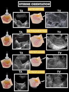 an x - ray shows the different stages of uterinel operation and how it works