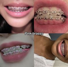 Cute Color Braces Ideas, Light Pink Braces Aesthetic, Braced Teeth, Braces Inspo Colors, Pink Braces Black Women, Pink Power Chain Braces, Clear Braces With Color Bands, Light Pink Braces, Hot Pink Braces