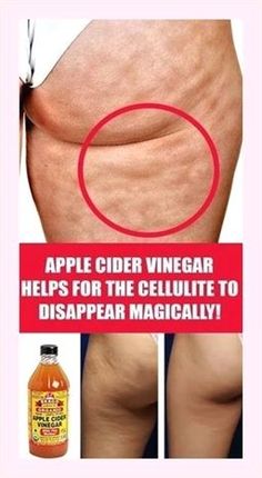 Surprising detail! Apple Cider Vinegar Remedies, Organic Apple Cider, Cold Sores Remedies, Organic Apple Cider Vinegar, Cold Home Remedies, Lose 40 Pounds, Natural Home Remedies, Cider Vinegar, Apple Cider Vinegar