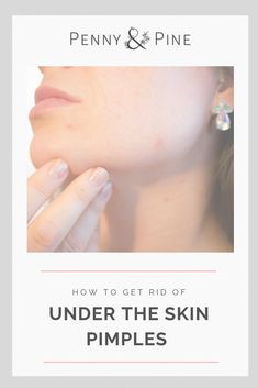 If you've ever dealt with an under the skin pimple, you know what I mean when I say that it's definitely the most painful and obnoxious type of pimple out there. The big question that I know you're probably looking for an answer to is how to get rid of under the skin pimples! We've got you covered--check out this blog! Pimple Under The Skin How To Get Rid Of, How To Treat Under The Skin Pimples, Heal Pimples Fast, Under The Skin Pimples How To Get Rid Of, How To Get Rid Of Pimples Under The Skin, Underskin Pimples Remedy, How To Get Rid Of Under The Skin Pimples, Under Skin Pimple Remedies, Deep Pimples Under Skin