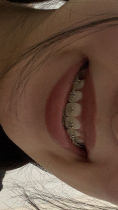 White Teeth Braces, Straight Teeth Braces, Braces Smile Aesthetic, Burgundy Braces Color, Silver Braces Aesthetic, Braces Vision Board, Braces Astethic, Good Teeth Aesthetic, Straight Teeth With Braces