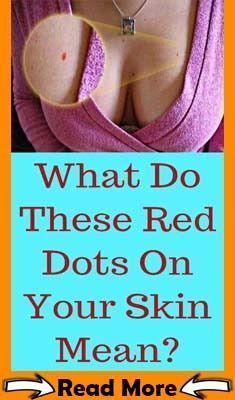 What do these red dots on your skin mean? Mole Removal, Heart Care, Lose 40 Pounds, Health Articles, Hair Tips, Red Dots