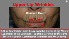 Upper Lip Wrinkles, Face Mapping, Mole Removal, Lip Wrinkles, Botox Fillers, Aesthetic Medicine, Lower Lip