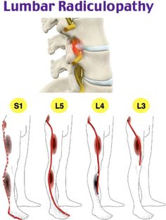 Lumbar Pain, Chronic Back Pain, Middle Back Pain, Sciatica Pain