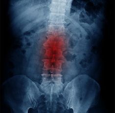 Degenerative disc disease (DDD) is one of the most common spinal problems affecting millions of people around the world. This condition, characterized by loss of elasticity and height of the intervertebral disc, can lead to serious pain and dysfunction of the spine. Let's look at nine key facts about degenerative disc disease that will help us better understand its nature and consequences. Intervertebral Disc, Physical Inactivity, Magnetic Resonance Imaging, Magnetic Resonance, Poor Posture, Spinal Cord, Back Muscles, Lifestyle Changes, Physical Therapy