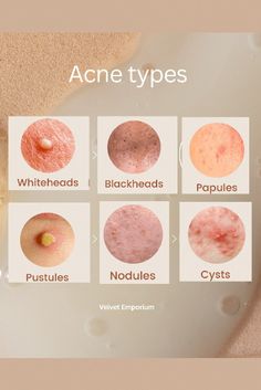 Acne Types And Causes, Face Acne Remedies, Papules Acne, Acne Aesthetic, Pustules Acne, Best Acne Scar Removal, Closed Comedones, Biology Project