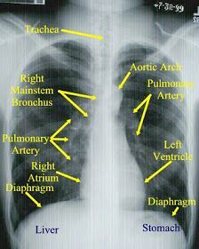 an x - ray shows the location of different lungs