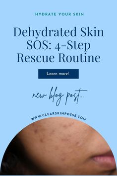 Is your skin feeling parched? Follow our 4-step rescue routine for dehydrated skin and restore your skin’s hydration levels for a fresh, clear appearance. For more skincare tips, make sure to click the pin! Dehydrated Skin, Wasting Time