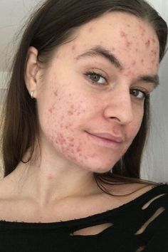 Girls With Acne, Acne Girl, Accutane Before And After, Beautiful Acne, Girl With Acne, Acne Positivity