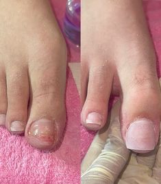 acrylic toe reconstruction 😮‍💨 - client dropped can on toe breaking it in half. - book with link in bio 💗 Acrylic Toes, Link In Bio, Nails, Quick Saves