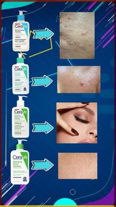 You can easily get rid of these blackheads by using natural or home remedies for blackhead treatment. Click to read How to get rid of blackheads diy| The best blackheads removal on nose| get rid of blackhads on face| get rid of blackheads on nose| how to get rid of blackheads naturally Cleanser Products, Skin Cleanser, Facial Skin Care Routine