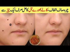 Face Black Spot Removal, Homemade Night Cream, Moles On Face, Expensive Jewellery, Bb Cream Reviews, Coconut Health, Red Moles, Glutathione Skin, Karbala Pictures