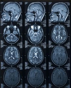 an mri scan shows multiple areas of the brain