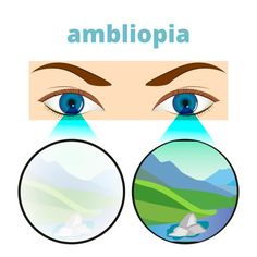 La #ambliopia può essere causata da malattie dell'occhio che, durante lo sviluppo dell'apparato visivo in età infantile (0-6anni), impediscono allo stimolo luminoso di raggiungere la retina. È importante effettuare una prima visita oculsitica nel bambino entro i 3-4 anni, ma si può anche anticipare entro il 1° anno di vita. ✺ https://www.mariaelisascarale.it/ambliopia/ Posterior Vitreous Detachment, Retina Surgery, Drooping Eyelids, Eye Function, Procreate Watercolor, Eye Facts, Lazy Eye, Brain Learning, Vision Problems