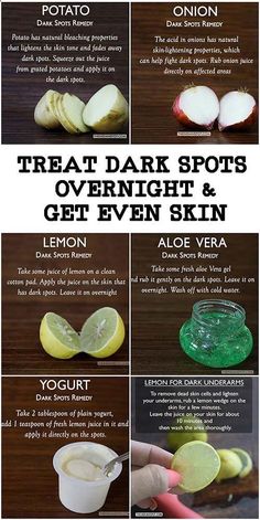 Pin on Some Acne Scar Tips Dark Spots Remedies, Fresh Aloe Vera Gel, Black Heads, Brown Spots Removal, Resep Diet, Skin Spots, Beauty Tips For Glowing Skin, Baking Soda Shampoo, Cold Remedies