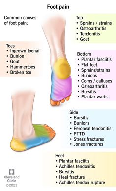 Foot Pain Chart, Therapist Notes, Gait Analysis, Anatomy 101, Plantar Fascitis, Pain Chart, Sports Tips, Heel Spur