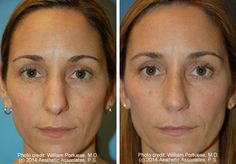 Wide nasal bones Facelift Before And After, Facial Surgery, Surgeon Doctor, Before After Photo, After Photos