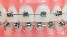 Ceramic Braces, Braces Colors, Dental Braces, Orthodontics Braces, Metal Braces, Teeth Braces, Dental Teeth