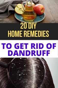 How To Get Ride Of Dandruff Fast At Home, How To Avoid Dandruff, Dandruff Home Remedies, Dry Scalp Remedy, Hair Growth Mask Diy, How To Treat Dandruff, Home Remedies For Dandruff, Diy Haircare, Rid Of Dandruff