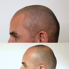 Hairline Tattoo, Hairline Tattoos, Tattoo Male, Regrow Hair Naturally, Clear Healthy Skin, Men's Hairstyle