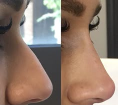 Nose Plastic Surgery, Nonsurgical Nose Job, Nose Surgery Rhinoplasty, Nose Fillers, Derma Fillers, Bulbous Nose, Rhinoplasty Nose Jobs, Rhinoplasty Before And After, Job Inspiration