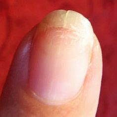 Here's how to repair split fingernails--try it, it really works! Split Nail Repair, Fix Broken Nail, Nails Care, Natural Detergent