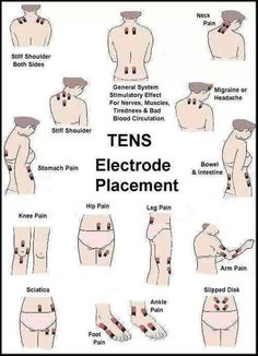 Tens Electrode Placement, Tens Unit Placement, K Tape, Tens Unit, Ten Unit, Hip Pain, Sciatica, Occupational Therapy, Knee Pain