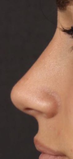 Perfect Nose Rhinoplasty, Nose Rhinoplasty, Nose Plastic Surgery, Nose Surgery Rhinoplasty, Nose Fillers, Nose Jobs, Rhinoplasty Nose Jobs, Nose Reshaping, Botox Lips