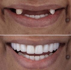 Permanent Dentures, Dental Content, Dental Post, Clinic Art, Hollywood Smile, Dental Logo Design, Dental Posts, Tooth Whitening