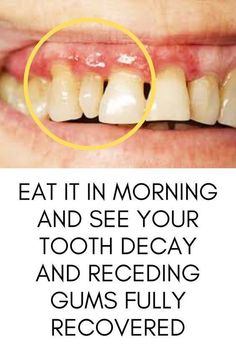 Remove Cavities and Tooth Decay From Your Teeth Naturally At Home Teeth Decay, Home Remedies For Cavities, Gum Surgery, Tooth Pain